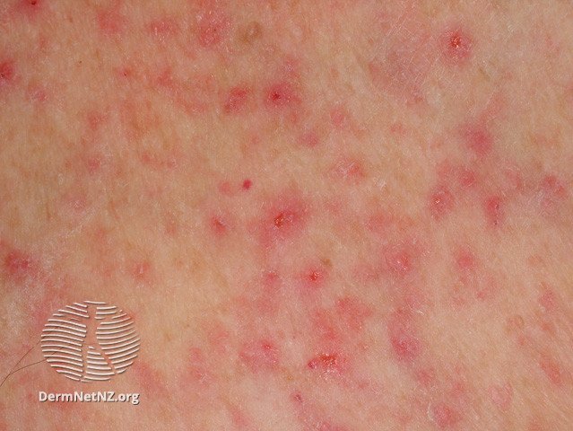 Miliaria rubra