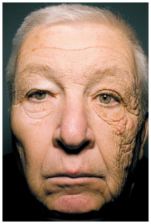 Photoaging: egyoldali napkárosodás