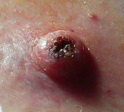 Keratoacanthoma