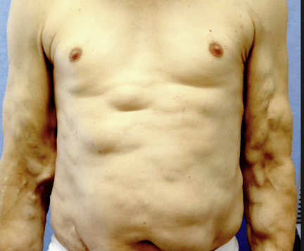 Benignus lipomatosis