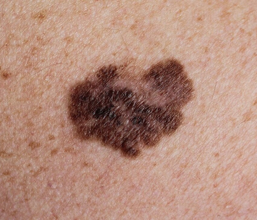 Melanoma malignum