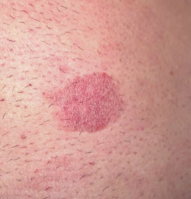 Mycosis fungoides