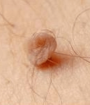 Papilloma
