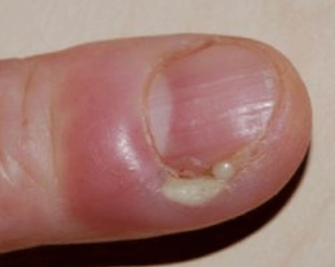 Paronychia