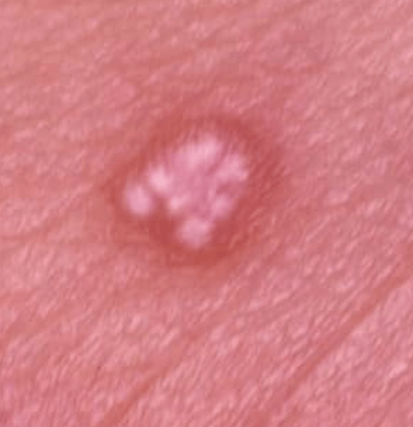 Pilomatricoma