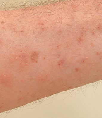 Scabies