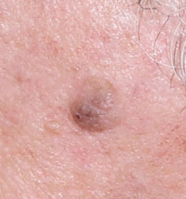 Seborrhoeás keratosis