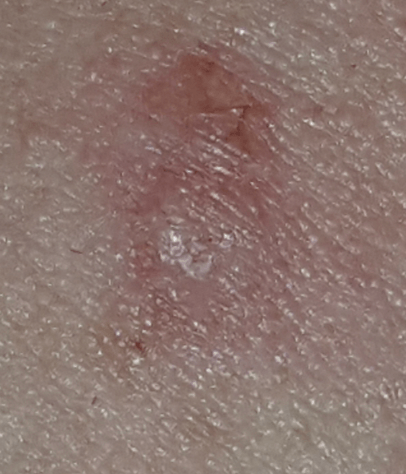 Trichoadenoma
