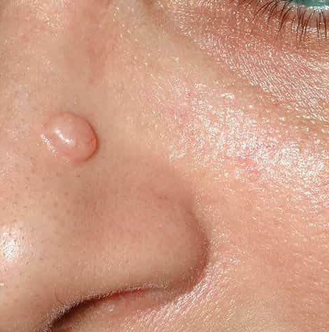 Trichoepithelioma