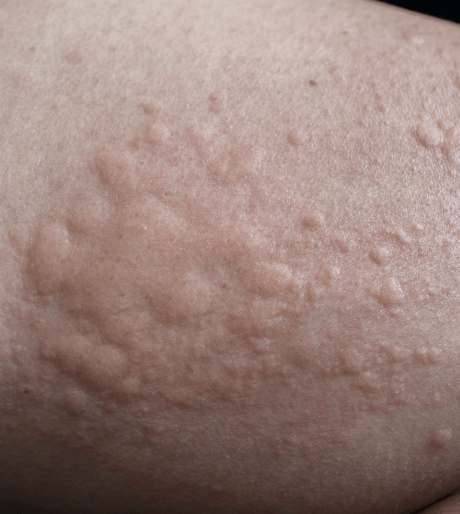 Urticaria