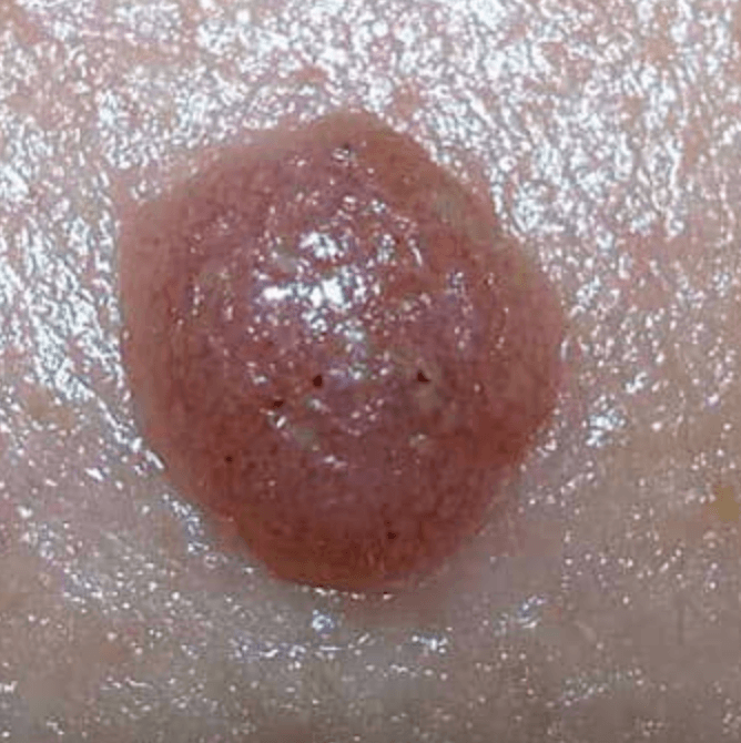 Világos sejtes acanthoma