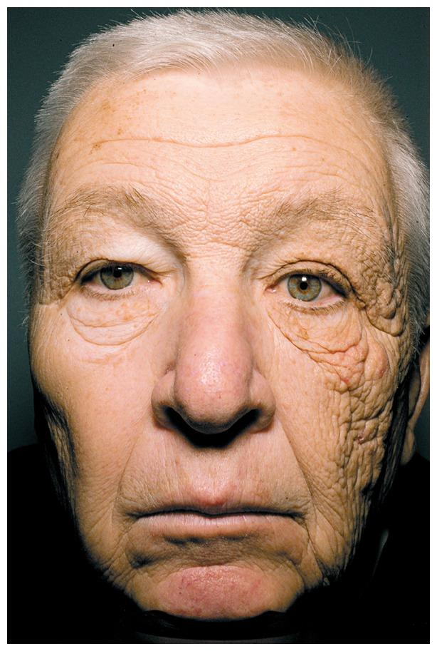 Photoaging: egyoldali napkárosodás