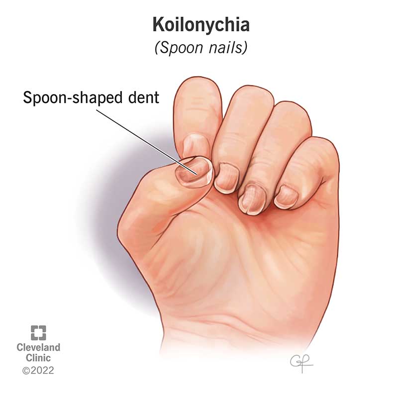 Koilonychia