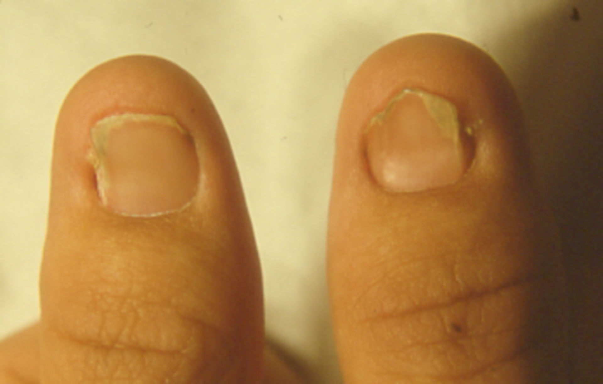 Nail-Patella Szindróma