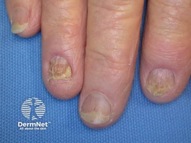 Onycholysis