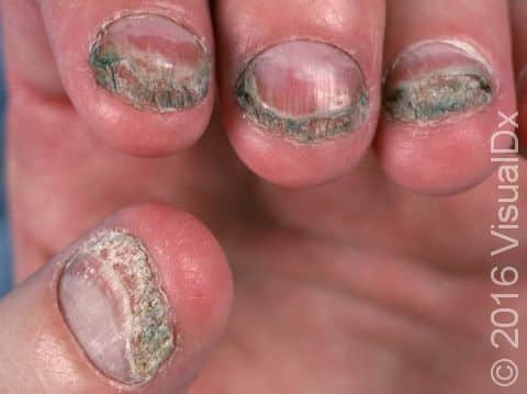 Onychomycosis